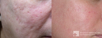 Acne surgery and Fraxel laser