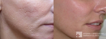 Acne surgery and Fraxel laser