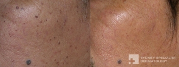 Fine wire diathermy for pigmented lesions