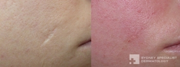 Immediately after filler for scar (surgery elsewhere)