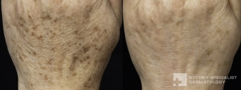 Fraxel Peel laser for pigmented lesions