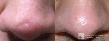 Filler to scar (surgery elsewhere)